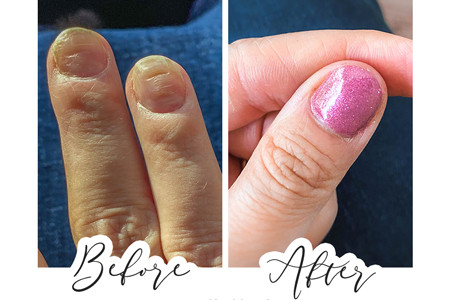Psoriasis nails Gel Manicure Leuven nail bar