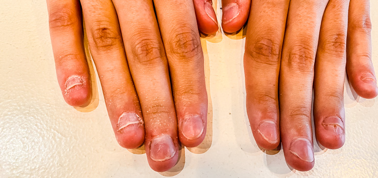 Nail biter ongles écaillés